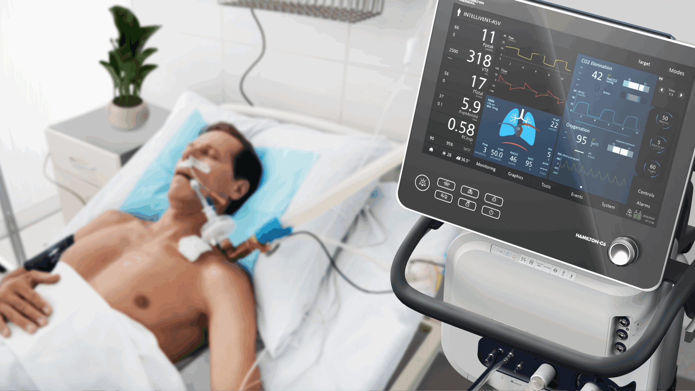 Hamilton-C6 ventilator touchscreen showing lung graphics and readings beside an intubated patient in a hospital bed